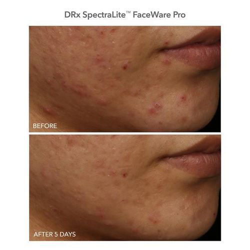 Light Therapy Beauty FaceWare Pro