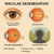 Macular Degeneration
