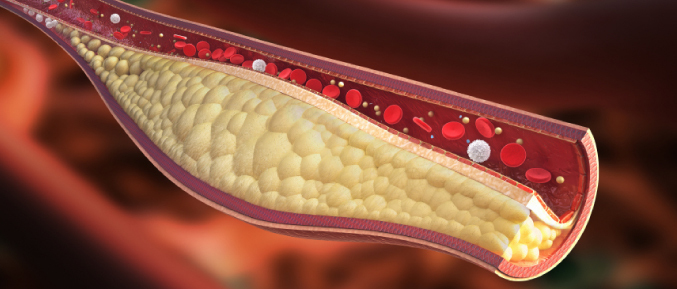 cholesterol